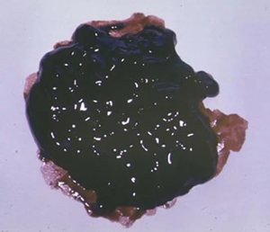 Кал черного цвета у пациента
