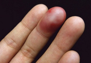Ушиб пальца - не всегда безобидная травма, иногда это может обернуться серьезными последствиями