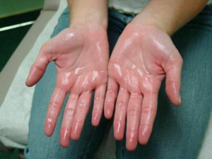 Для лечения сильной потливости рук нужно выявить причину