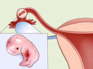 Признаки внематочной беременности на ранних сроках