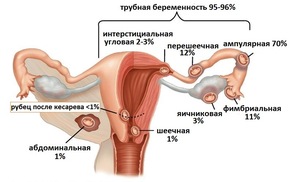 Различные виды внематочной беременности