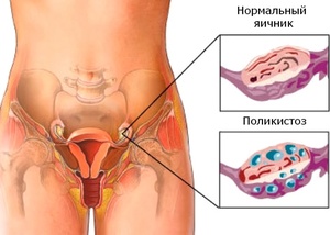 Как лечить поликистоз яичников у женщины