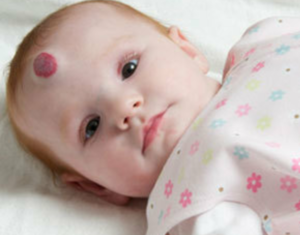 Причины появления гемангиомы у новорожденных и способы лечения