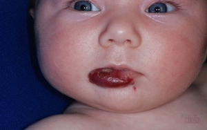 Опасность гемангиомы для младенцев