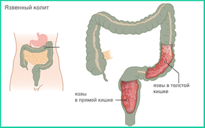 Причины воспаления кишечника