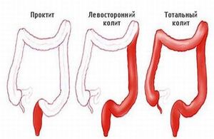 Лечение патологии кишечника