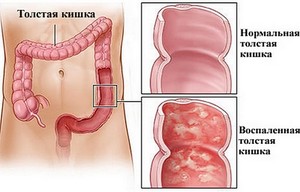 Признаки воспаления кишечника