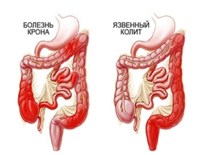 Лечение кишечника народными средствами