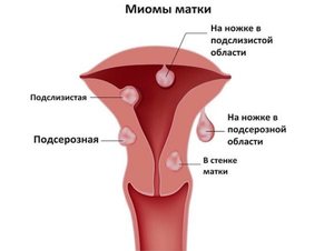 Какими должны быть размеры миомы матки для операции