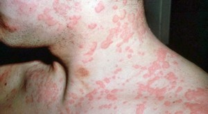 На фото - кожная аллергия, сыпь и раздражение
