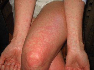 Симптомы аллергии - сыпь, зуд на коже