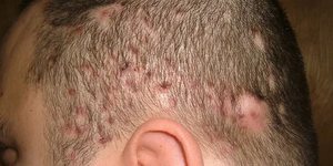 Дерматофития кожи головы у пациента
