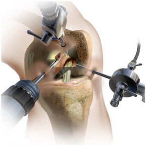 Как производится проникновение в колено при операции артроскопии