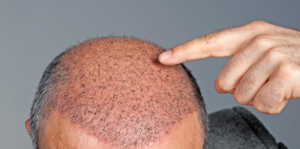 Прыщи на голове под волосами и методы их лечение