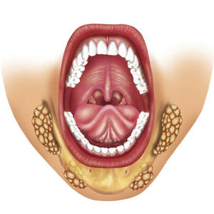 Лечение воспаления слюнной железы под языком