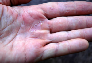Грибок как причина трещин на коже рук