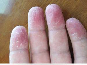 Авитаминоз как причина трещин на коже рук