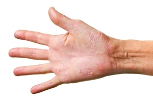 Лечение трещин кожи на руках