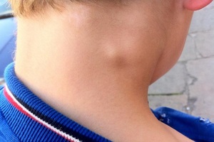 Симптомы и лечение хронического лимфаденита шеи у детей