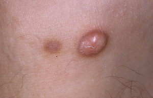 Дерматофиброма - новообразование кожи