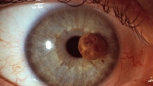 Основные признаки и стадии развития меланомы глаза