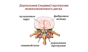 Виды протрузии межпозвонковых дисков шейного отдела