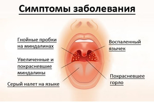 Симптомы заболевания ангиной