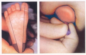 Неонатальный скрининг новорожденного