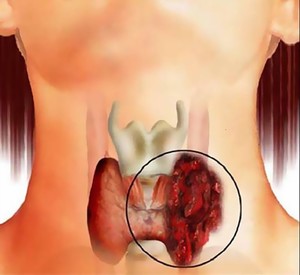 Симптомы кисты щитовидной железы