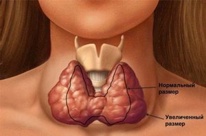Какие виды кист щитовидной железы