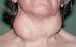 Симптомы зоба щитовидной железы