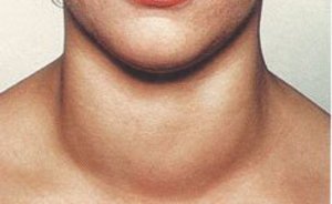 Какие могут бфть изменения щитовидной железы