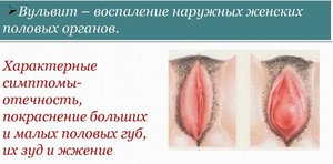 Отек половых губ и влагалища - диагностика болезней