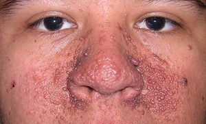 Туберозный склероз на лице
