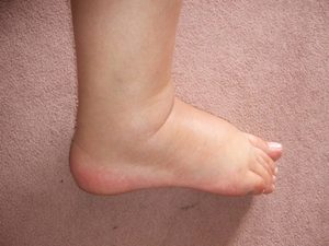 Какие могут быть причины отека ног