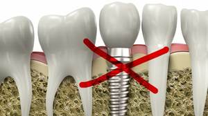Имплантация зубов и ее плюсы