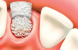 Особенности имплантации и протезирования зубов 