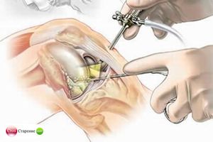 Проведение операции артроскопии