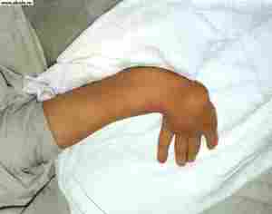 Восстановление кисти руки после перелома лучевой кости 