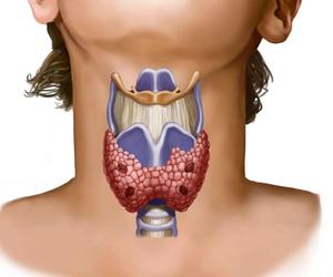  какие последствия если удалили щитовидку полностью