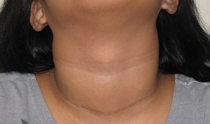  как проходит операция удаления узла щитовидной железы