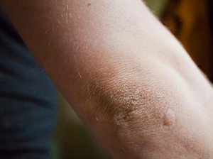 Какие наруения в организме приводят к шелушению кожи на локтях