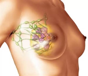 Симптомы кисты молочной железы у женщин