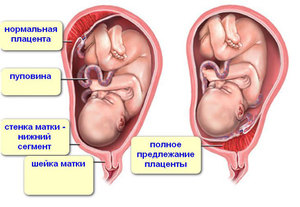 Причины нарушения маточного плацентарного кровотока