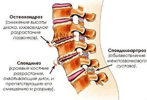 Боль в спине справа выше поясницы: причины, возможные заболевания, методы лечения, отзывы