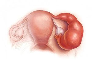 Лечение аднексита народными средствами при беременности thumbnail