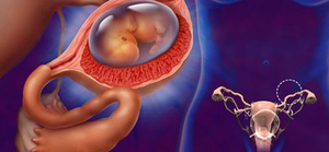 При внематочной беременности тест показывает 2 полоски или одну
