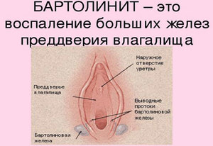 Препараты при воспалении борталиновой железы