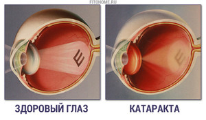 Народжные способы лечения катаракты