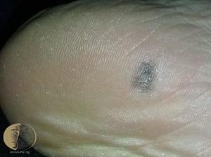 Лентигинозная меланома кожи